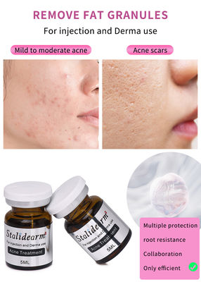 Stalidearm Dermal Fillers Acne Treatment Acne Healing and Blemish Reduction के लिए इंजेक्शन सीरम