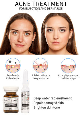 Stalidearm मुँहासे उपचार इंजेक्शन सीरम Mesotherapy पौष्टिक कोई साइड इफेक्ट